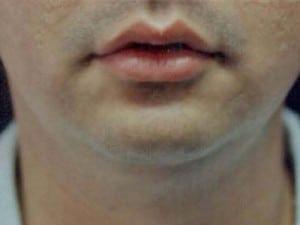 Chin Implant before at Cosmetic Surgery Dallas in Dallas, TX