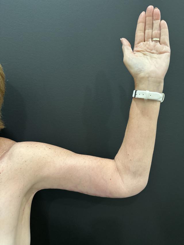 Arm Lift after at Cosmetic Surgery Dallas in Dallas, TX
