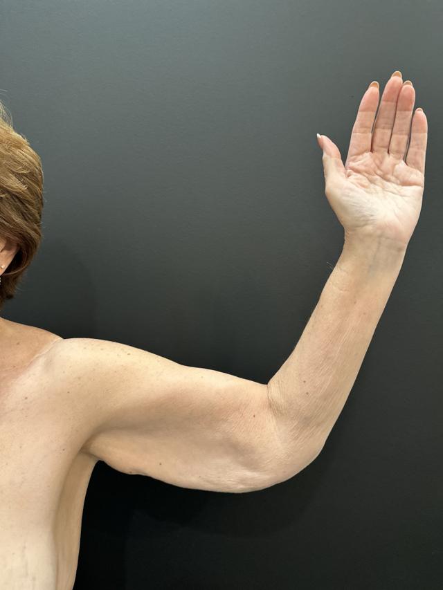 Arm Lift before at Cosmetic Surgery Dallas in Dallas, TX