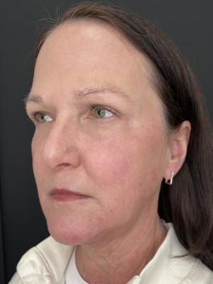 Cosmetic Surgery Dallas laser treatment after — Dallas, TX