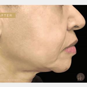 Cosmetic Surgery Dallas laser treatment after — Dallas, TX