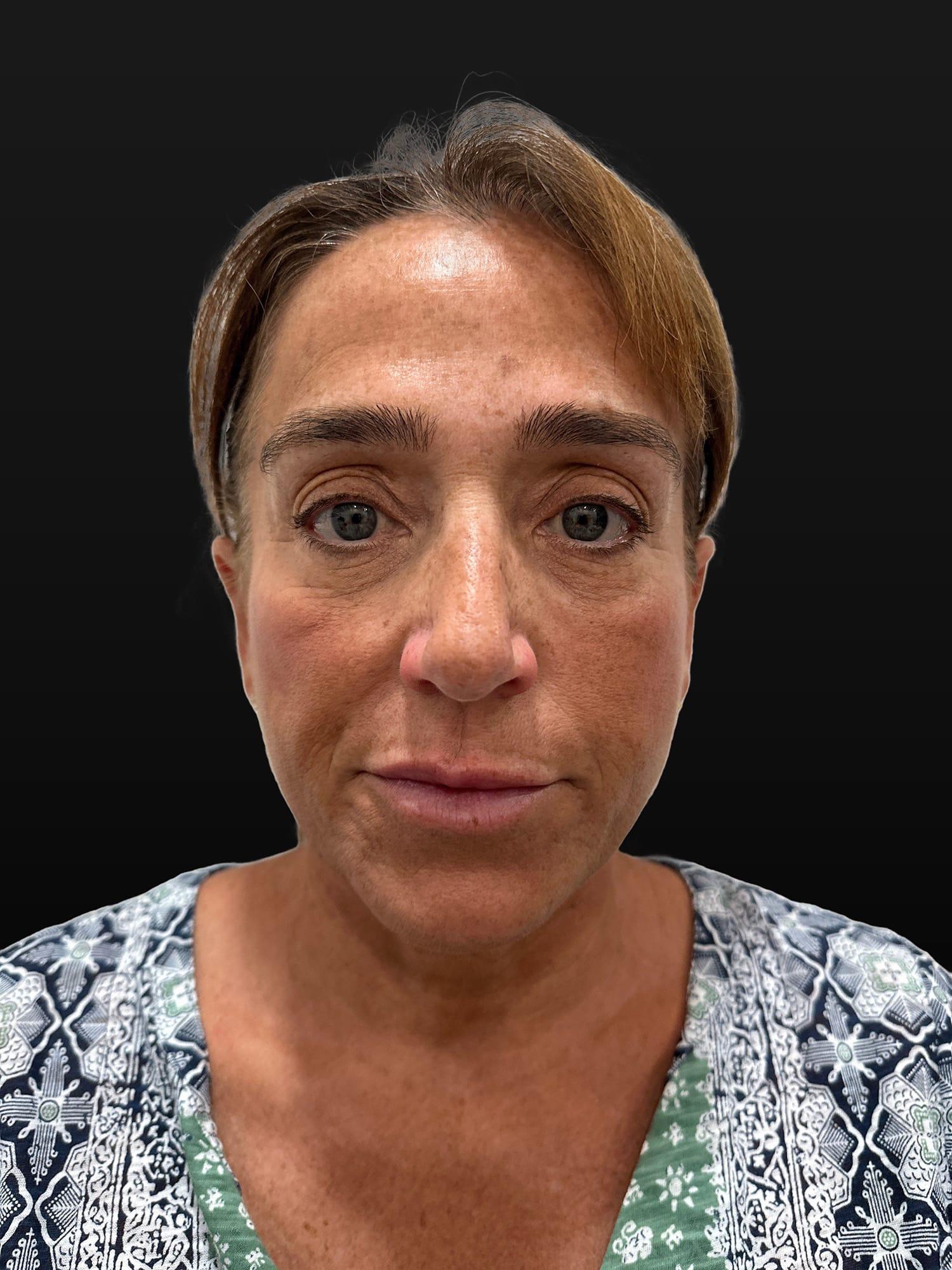 Cosmetic Surgery Dallas blepharoplasty after — Dallas, TX