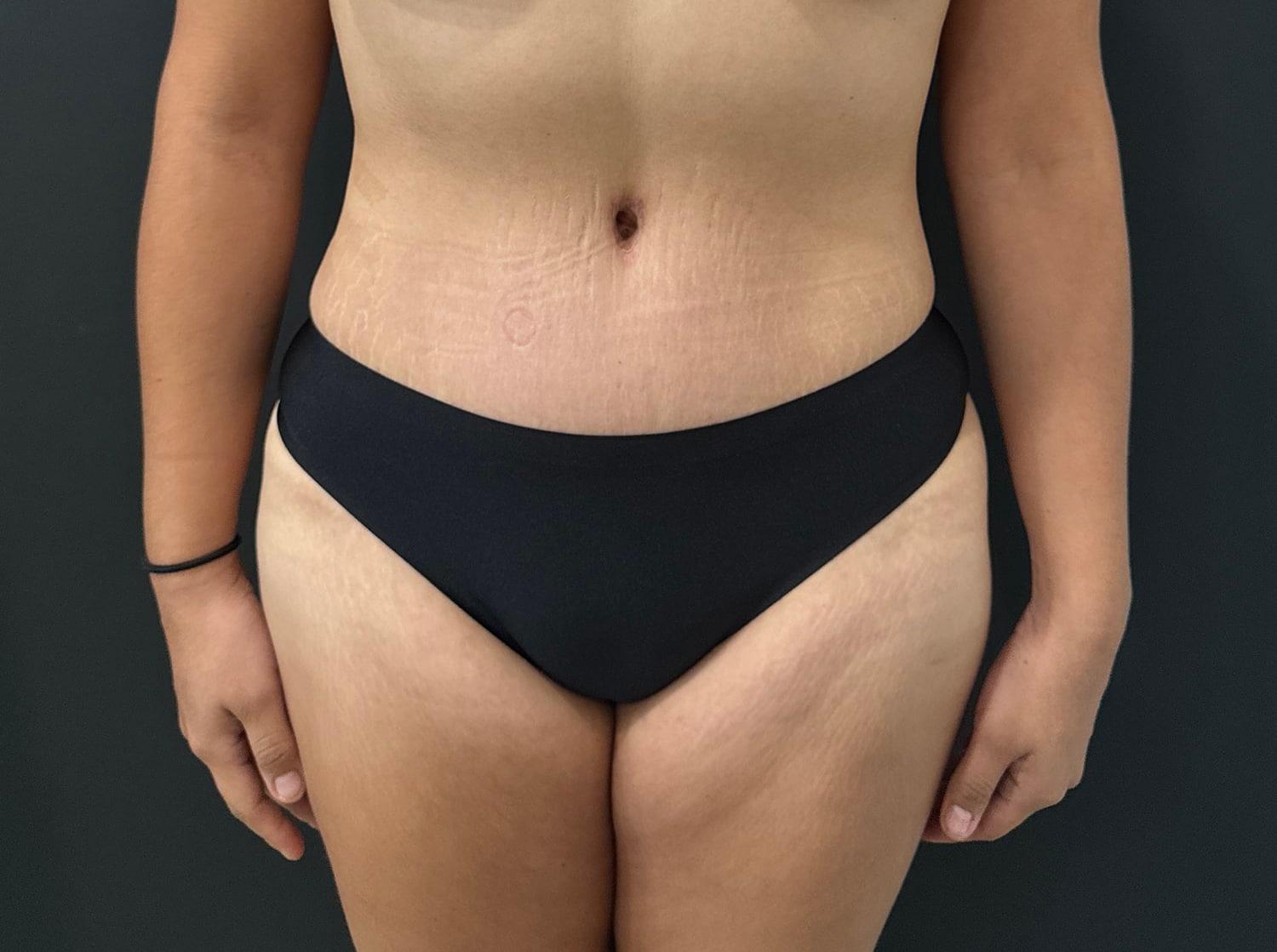Cosmetic Surgery Dallas liposuction after — Dallas, TX