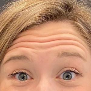 Botox before at Cosmetic Surgery Dallas in Dallas, TX