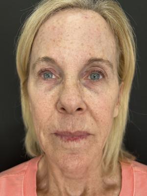 Laser Skin Resurfacing before at Cosmetic Surgery Dallas in Dallas, TX
