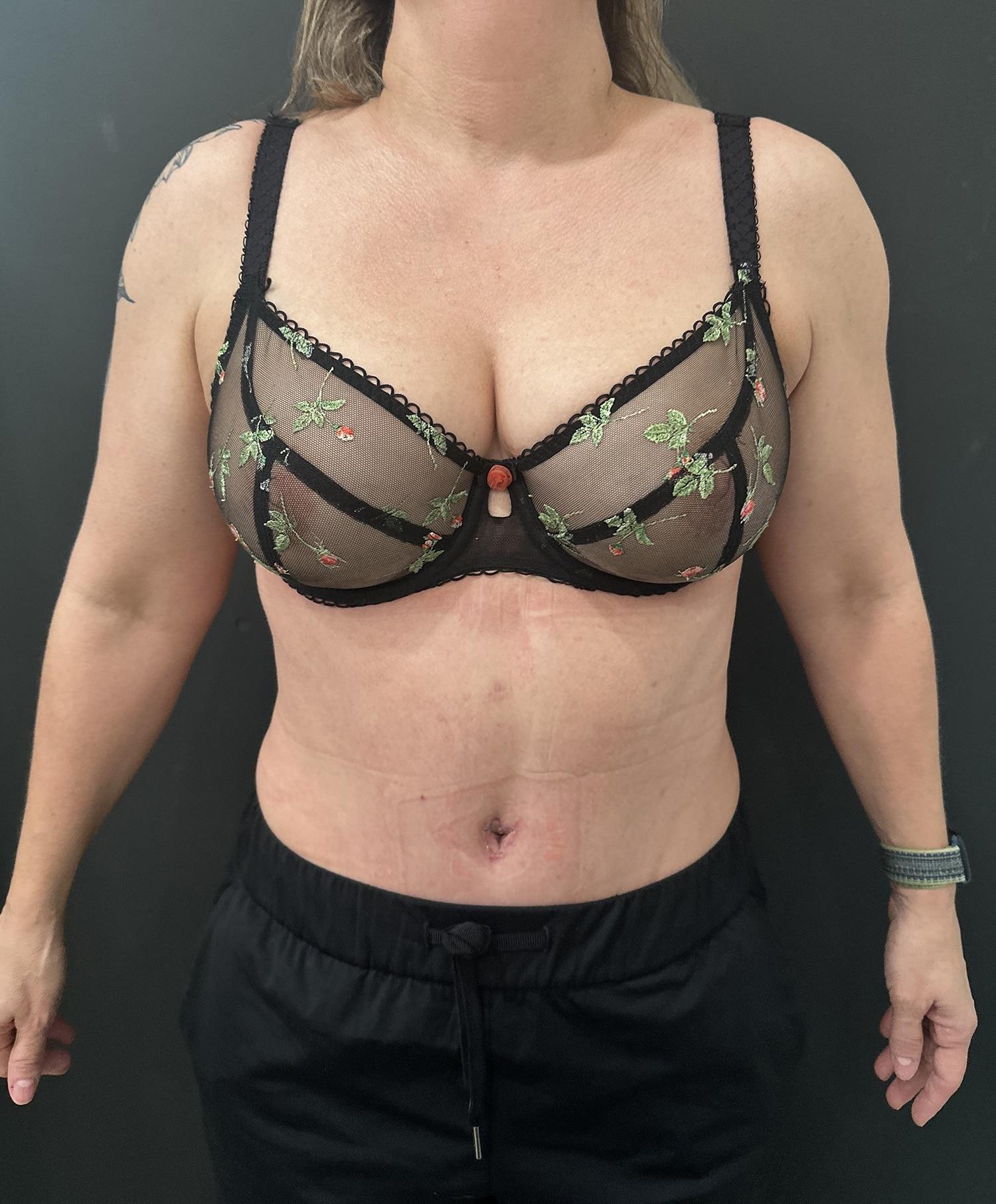 Cosmetic Surgery Dallas tummy tuck after — Dallas, TX