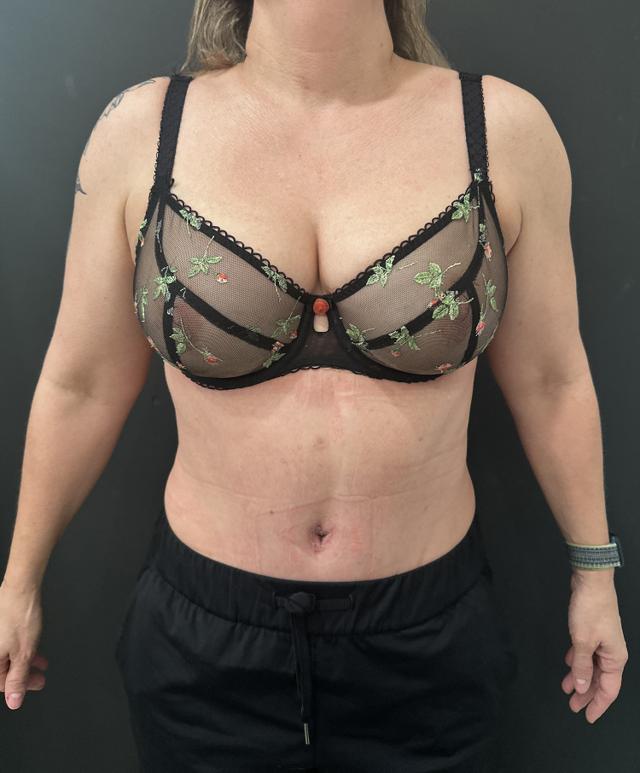 Tummy Tuck after at Cosmetic Surgery Dallas in Dallas, TX