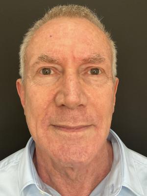 Cosmetic Surgery Dallas laser treatment after — Dallas, TX