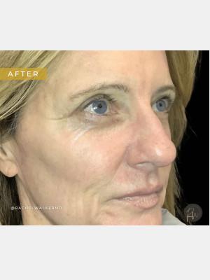Blepharoplasty after at Cosmetic Surgery Dallas in Dallas, TX