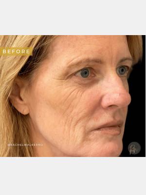 Blepharoplasty before at Cosmetic Surgery Dallas in Dallas, TX