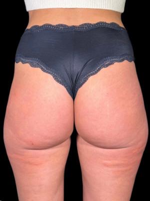 Cosmetic Surgery Dallas bbl after — Dallas, TX