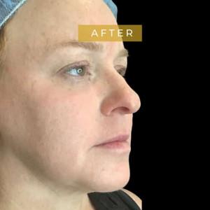 Fat Transfer after at Cosmetic Surgery Dallas in Dallas, TX