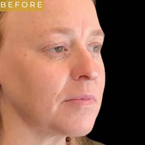 Fat Transfer before at Cosmetic Surgery Dallas in Dallas, TX