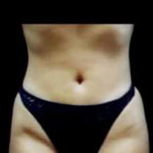 Liposuction after at Cosmetic Surgery Dallas in Dallas, TX