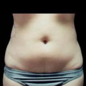 Liposuction before at Cosmetic Surgery Dallas in Dallas, TX