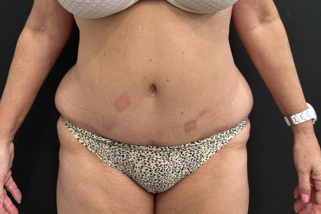 Liposuction before at Cosmetic Surgery Dallas in Dallas, TX