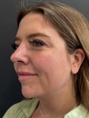 Cosmetic Surgery Dallas liposuction after — Dallas, TX