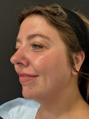 Neck Liposuction before at Cosmetic Surgery Dallas in Dallas, TX