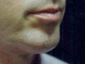 Chin Implant after at Cosmetic Surgery Dallas in Dallas, TX