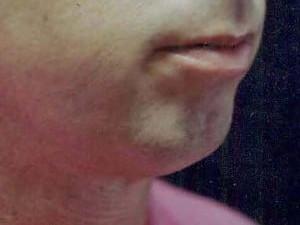 Chin Implant before at Cosmetic Surgery Dallas in Dallas, TX