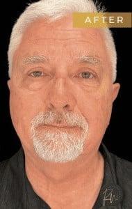 Cosmetic Surgery Dallas blepharoplasty after — Dallas, TX