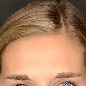 Botox after at Cosmetic Surgery Dallas in Dallas, TX