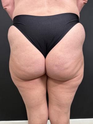 Brazilian Butt Lift before at Cosmetic Surgery Dallas in Dallas, TX