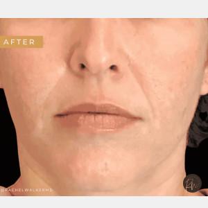 Cosmetic Surgery Dallas laser treatment after — Dallas, TX
