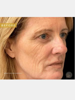 Chemical Peel before at Cosmetic Surgery Dallas in Dallas, TX