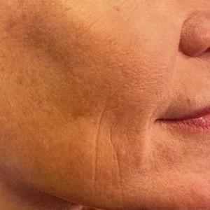 Chemical Peel before at Cosmetic Surgery Dallas in Dallas, TX