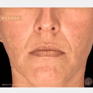 Laser Skin Resurfacing before at Cosmetic Surgery Dallas in Dallas, TX