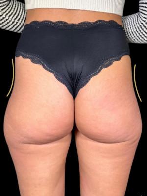 Brazilian Butt Lift before at Cosmetic Surgery Dallas in Dallas, TX