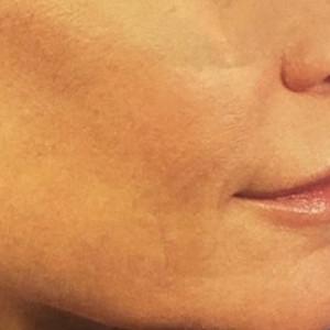 Cosmetic Surgery Dallas laser treatment after — Dallas, TX