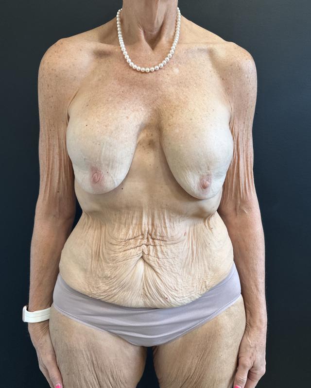 Mommy Makeover before at Cosmetic Surgery Dallas in Dallas, TX