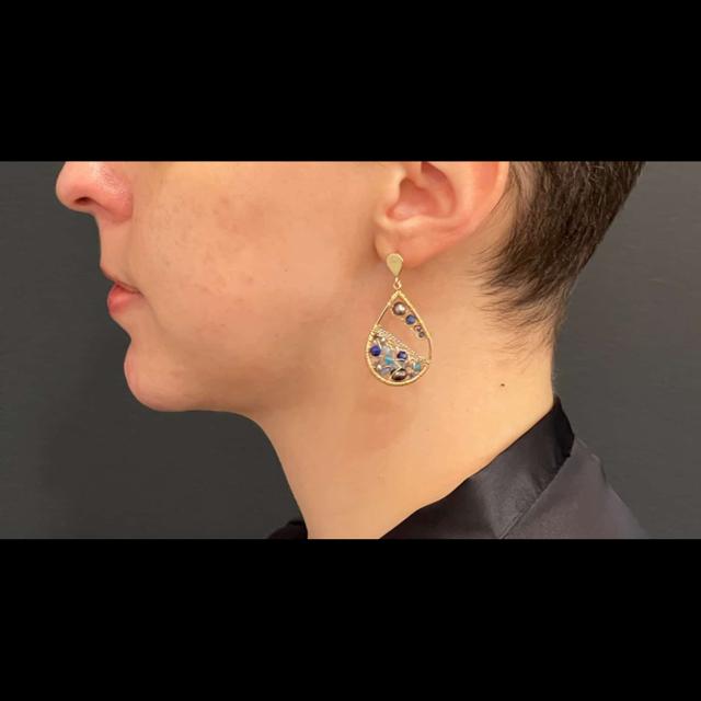 Chin Implant after at Cosmetic Surgery Dallas in Dallas, TX