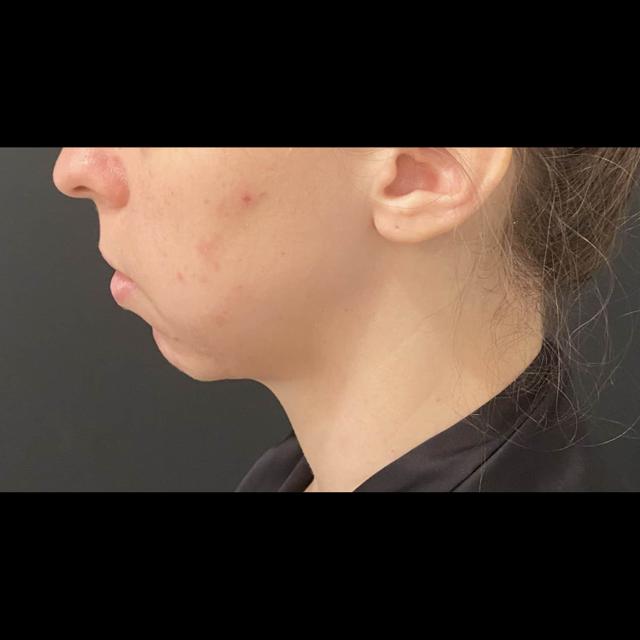 Chin Implant before at Cosmetic Surgery Dallas in Dallas, TX