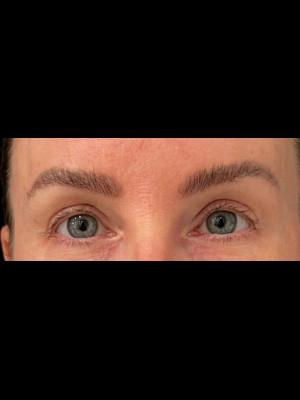 Cosmetic Surgery Dallas blepharoplasty after — Dallas, TX