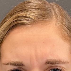 Botox before at Cosmetic Surgery Dallas in Dallas, TX