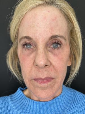 Cosmetic Surgery Dallas laser treatment after — Dallas, TX