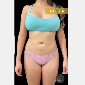 Liposuction after at Cosmetic Surgery Dallas in Dallas, TX
