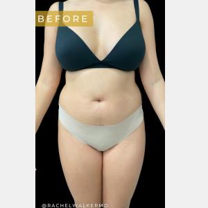 Liposuction before at Cosmetic Surgery Dallas in Dallas, TX