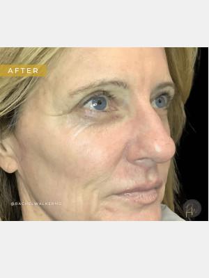 Cosmetic Surgery Dallas laser treatment after — Dallas, TX