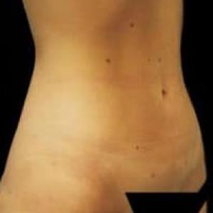 Liposuction after at Cosmetic Surgery Dallas in Dallas, TX