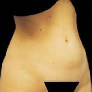 Liposuction before at Cosmetic Surgery Dallas in Dallas, TX