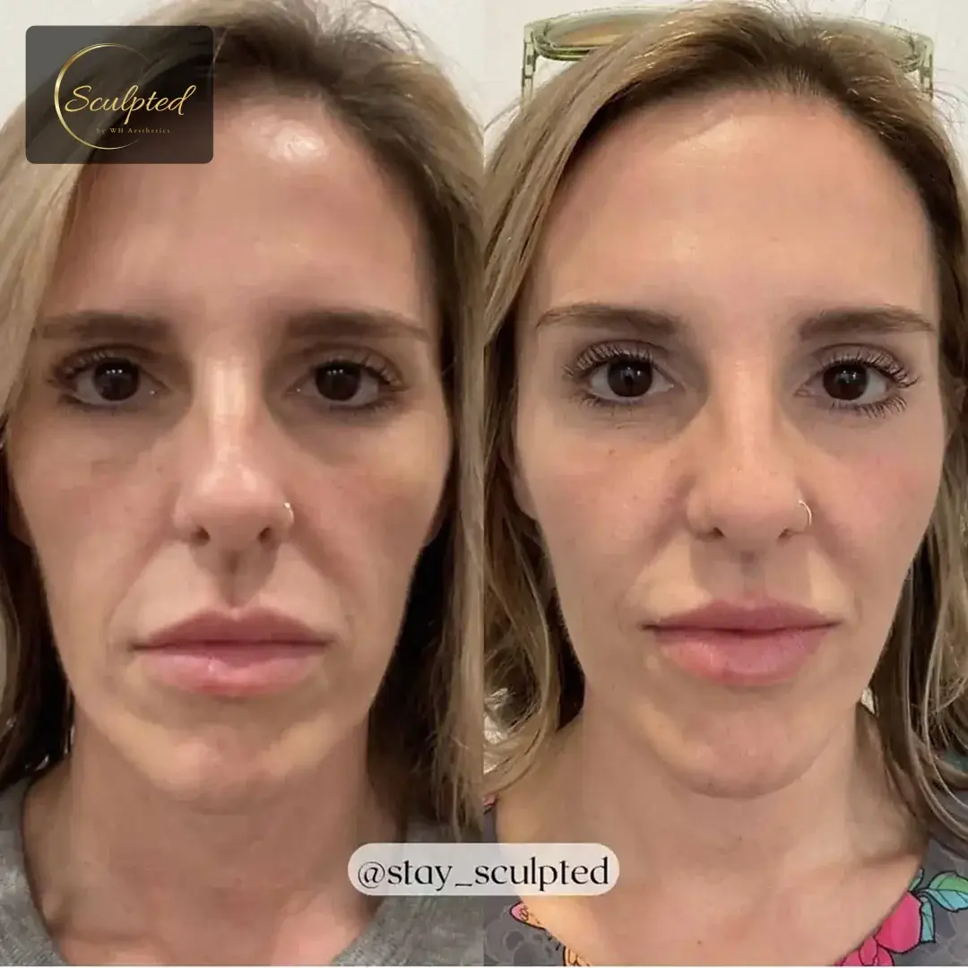 Sculpted by WH Aesthetics bbl result — Columbia, SC