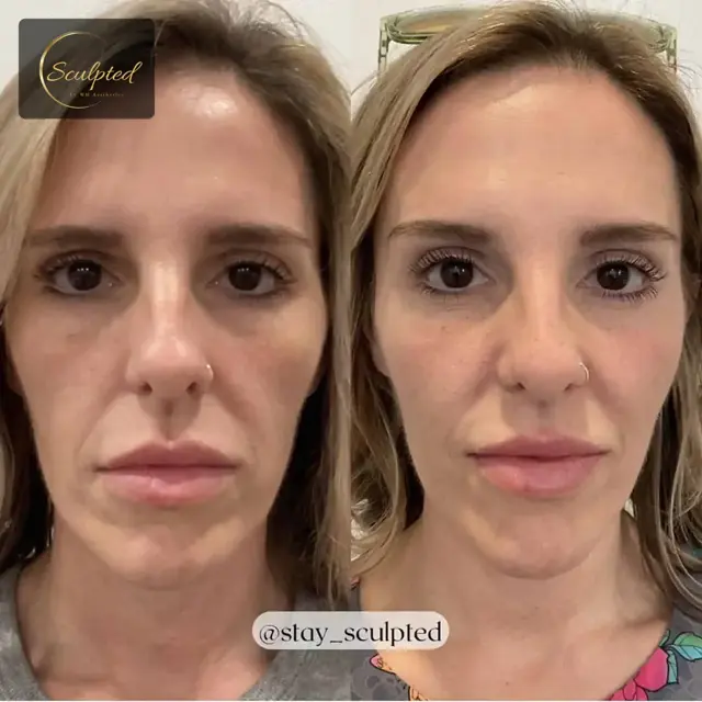 Brazilian Butt Lift result at Sculpted by WH Aesthetics in Columbia, SC