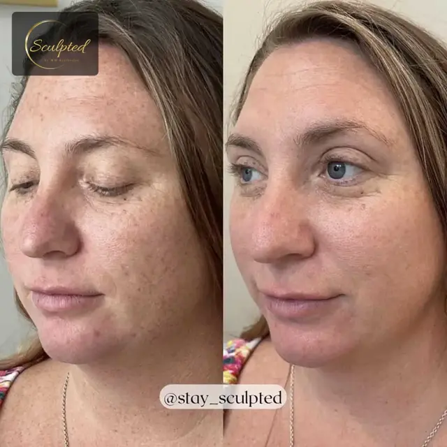 Brazilian Butt Lift result at Sculpted by WH Aesthetics in Columbia, SC
