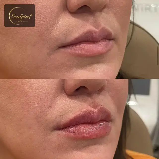 Lip Filler result at Sculpted by WH Aesthetics in Columbia, SC