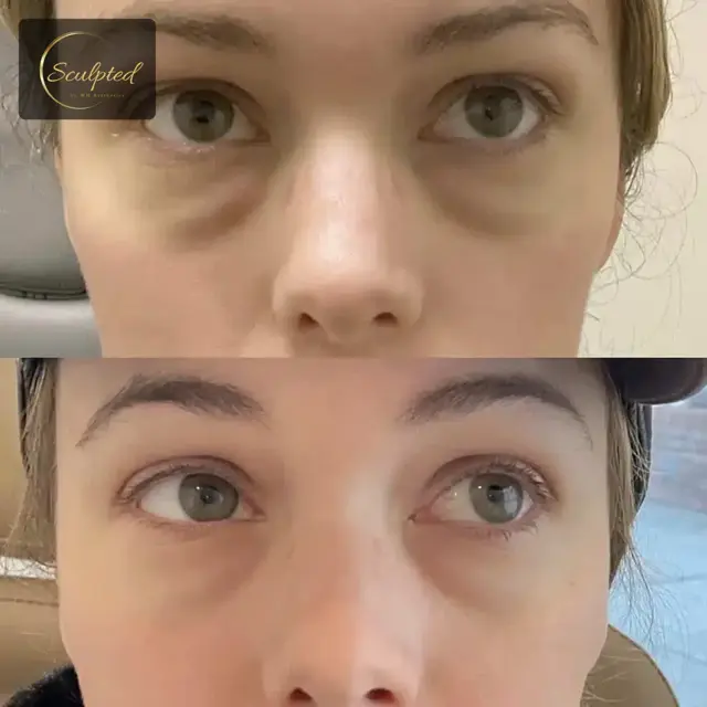 Jawline Filler result at Sculpted by WH Aesthetics in Columbia, SC