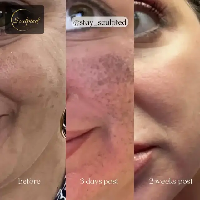 Brazilian Butt Lift result at Sculpted by WH Aesthetics in Columbia, SC